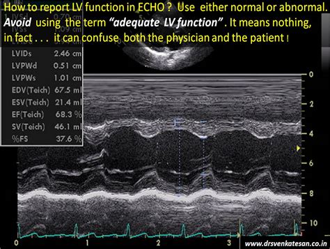 lv cd m2|Echocardiography.